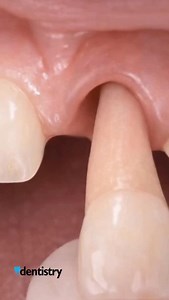 109K views · 58 reactions | 醴 Dental Avulsion = REAL EMERGENCY  A...