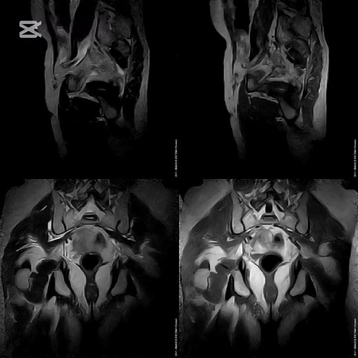 MRI Pelvis prostate protocol