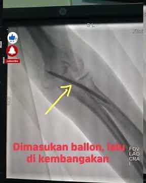 Proses tindakan Angiography Venoplasty | #cathlab #vaskuler