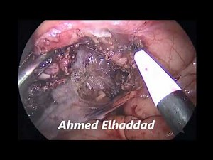 laparoscopic appendectomy difficult