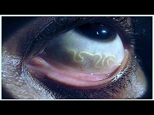 The Worms That Can Crawl Under Your Skin| Zoonotic hookworm