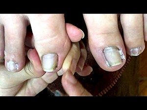 HOW TO CUT THICK TOENAILS - Toenail Cleaning Satisfying #300