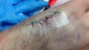 Man has operation to have microchip inserted in his hand