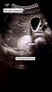 Hamenagioma /adrenal mass #adrenal #gland #radiologist #dr_wasi_ultrasound #abdominalultrasound # | Ultrasound made easy