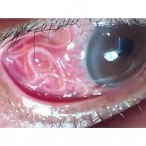 #Wuchereria____bancrofti É um nematódeo causador da filariose linfática. O parasito adulto tem de dois a seis centímetros, enquanto as microfilárias possuem de 0,2 a 0,3 mm. A fêmea do mosquito do gênero Culex ingere a forma microfilária (1) durante a picada da pessoa infectada. As microfilárias, na cavidade geral do mosquito (sofrem mudas até larvas infectantes), dirigem-se para a probóscide, rasgando-a e penetrando a pele do hospedeiro por alguma abrasão. Atingem a circulação, permanecendo aí 