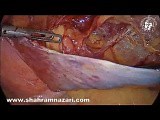 The Case of Huge Lipoma of the Spermatic Cord • Video • MEDtube.net