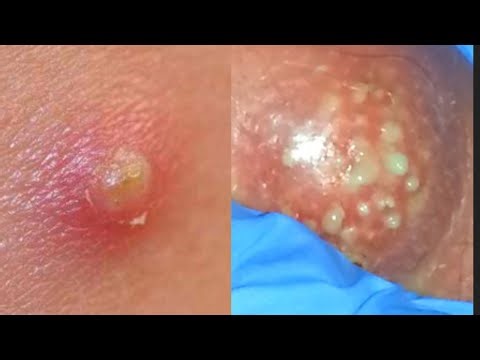 Carbuncles! Are they just Boils? What is a Carbuncle?