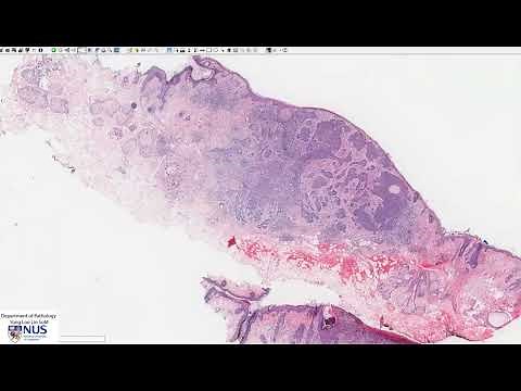 Skin: Basal cell carcinoma Microscopy - Talking slide