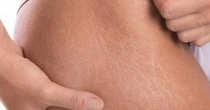 Cinco efectivos remedios caseros para combatir y eliminar estrías