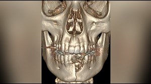 Vape pen explosion shatters boy’s jaw, breaks his teeth