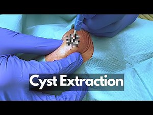Cute & Fast Lil Cyst Extraction!~ | CONTOUR DERMATOLOGY