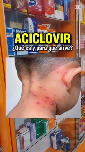Aciclovir: Qué es, Dosis y Cómo se Toma