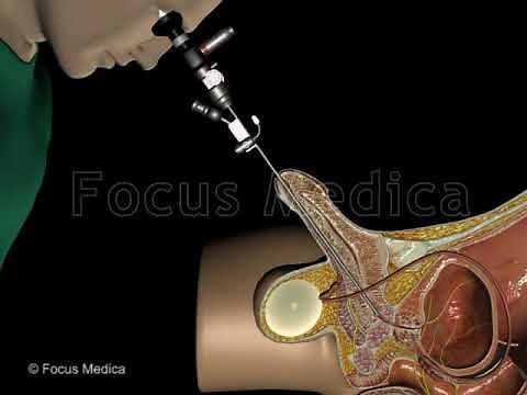 Cystoscopy - Animated Atlas of BPH and OAB