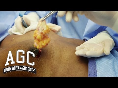 Gynecomastia Patient Narrates His Own Gyno Treatment - Austin Gynecomastia Center
