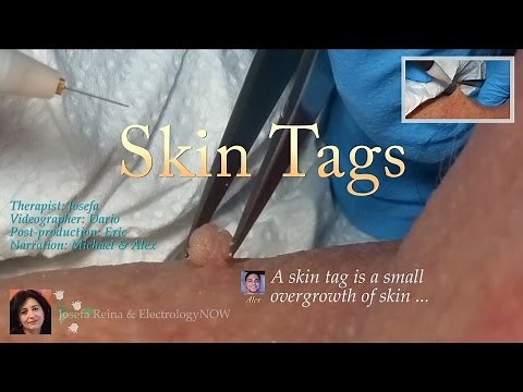 Josefa: Skin Tag treatment