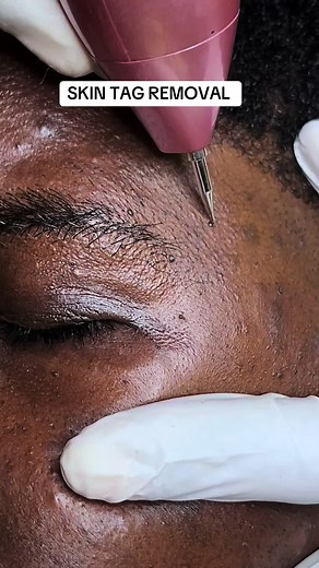 Remove tour skin tags now before it multiplies #fyp #maxluxespa6 #skintagremoval #skintag #skintags #fypviral