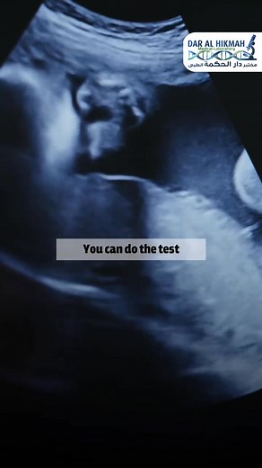 فحص جينات الجنين NIPT فحص سهل ودقيق جدا بنسبة تصل الى 99 % بيكشف عن أهم المتلازمة الي ممكن تصيب الجنين : متلازمة داون , متلازمة باتو , متلازمة ادوارد وحتى بيكشف عن جنس الجنين ومن الاسبوع العاشر للحمل أحجزي فحصك الآن بمختبر دارا لحكمة الطبي بخصم خاص ولفترة محدودة واطمني على صحتك وصحة جنينك NIPT Test Very easy and accurate test up to 99% Reveals the most important syndrome that can affect the fetus: Down syndrome, Patau syndrome, Edward syndrome And even reveals the sex of the fetus and from the t