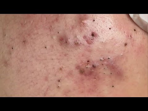 Suri Job 108: AWESOME STUBBORN BLACKHEADS