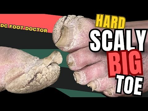 Hard Scaly Big Toe