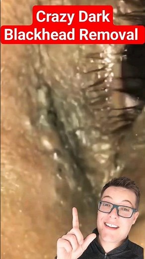 Shocking BLACKHEAD REMOVAL - Solar Comedones Extraction #shorts
