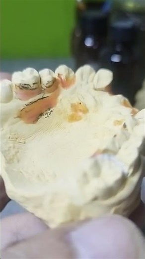 Making Denture