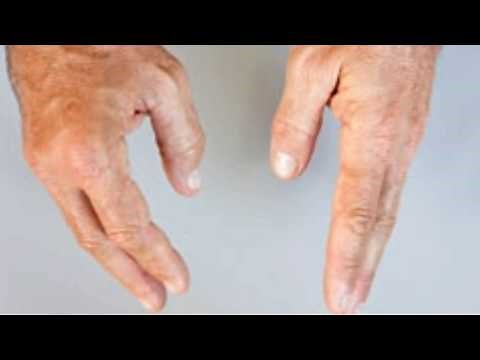 Swollen Finger Joints