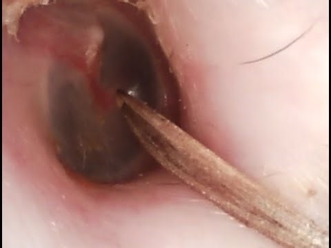 Insect removal in the external auditory canal