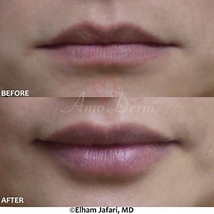 👁 Introducing Restylane Kysse, the newest filler specifically developed for the Lips. Restylane Kysse is used to add volume to lips for a natural-looking pout and sculpt softer and fuller lips that are more kissable according to clinical studies! Restylane Kysse can also help to improve the color and texture of the lips and reduce the fine lines and wrinkles above the mouth! _____________________ 💵 Introductory offer: For a limited time, we are offering Restylane Kysse injection by Dr. Jafari 
