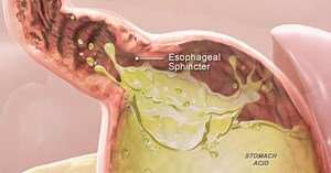 7 remédios naturais para azia que todos deveriam saber