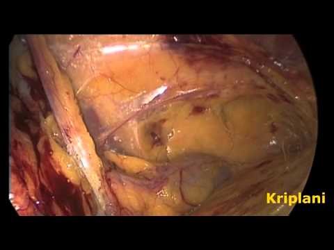 Laparoscopic Inguinal (groin) Hernia Repair surgery (TAPP Approach)