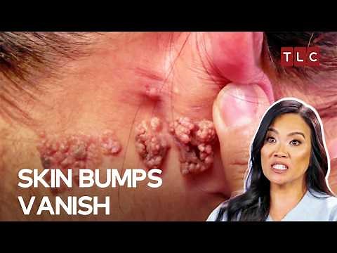 Dramatic Skin Treatment By Dermatologist Dr Lee | Dr. Pimple Popper S2 E5 | TLC