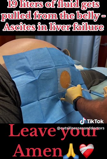 Ascites in Liver Failure - Understanding the Process of Paracentesis