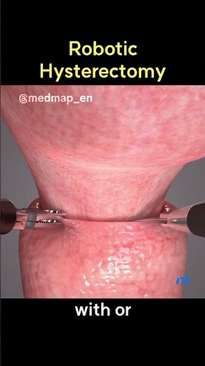 Robotic Hysterectomy