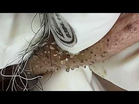 Acne treatment for Spa Linh Mun 2023 #004