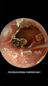 What Was Hiding Inside This Ear? #eardoctor #satisfying #earwaxremoval #ear #audiology