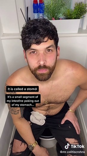 Reply to @fornite.girl75 A stom@ is an abdominal opening connected to your digestive system to allow waste to be diverted out of your body.