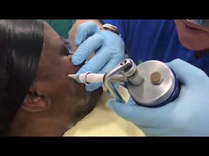 Treating Dermatosis Papulosa Nigra (DPN)