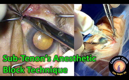 Sub-Tenon’s Anesthetic Injection Technique