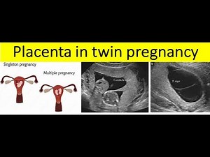 Anatomy of Twin Placenta (Part 1) | Monochorionic vs Dichorionic Twins | MBBS Embryology