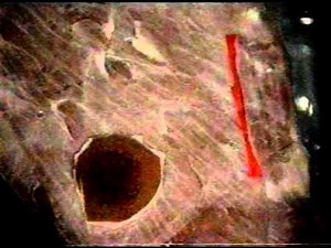 Rectus sternalis muscle