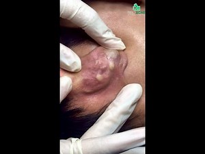 Removing Behind-the-Ear Cyst: Close-Up Extraction