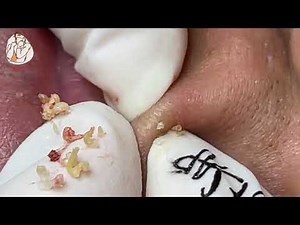 Satisfying and Relaxation With NaSa Beauty Spa #1 black point and acne extraction