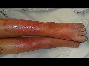 Home Remedies for Cellulitis | Cellulite removal and treatment