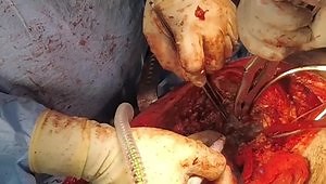 Femur - Proximal Femur Replacement