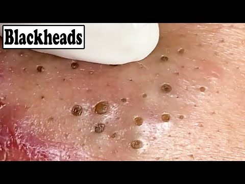 Deep Hard Big Removal Of Blackheads , Nose , Ear