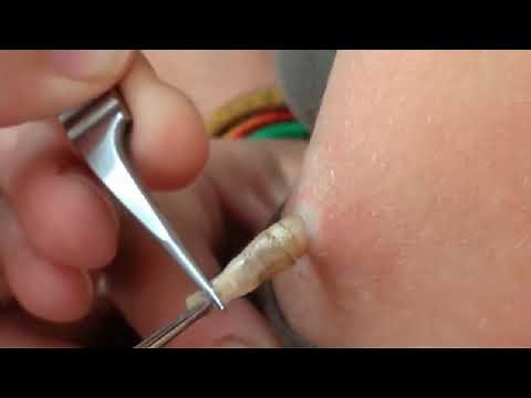 Bot Fly, Botflies, Bot Fly Removal! Dermatology