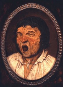 Meige's syndrome - Alchetron, The Free Social Encyclopedia