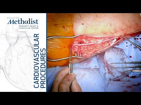 In Situ Femoral to Posterior Tibial Artery Bypass (S. Edeiken, MD, M. Zubair, MD, T. Vowels, MD)