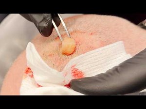 SCALP CYST!
