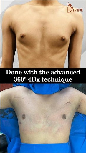Flat Chest, Full Confidence: Gynecomastia Gone with 360° 4Dx